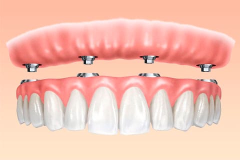 protesis dental fija sobre implantes dentales