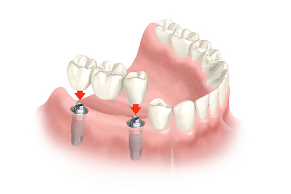 Prótesis de dientes postizos.